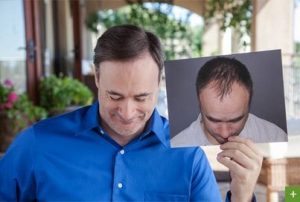 Trasplante de cabello Antes y Después 37