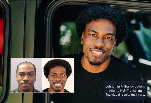 Johnathin R. Bosley patient.
Atlanta Hair Transplant individual results may vary.