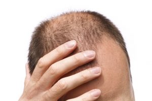 Bosley - Hair Thinning Man Image