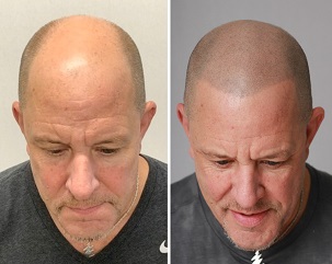 before and after smp