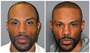 Bosley patient Ebony before and after