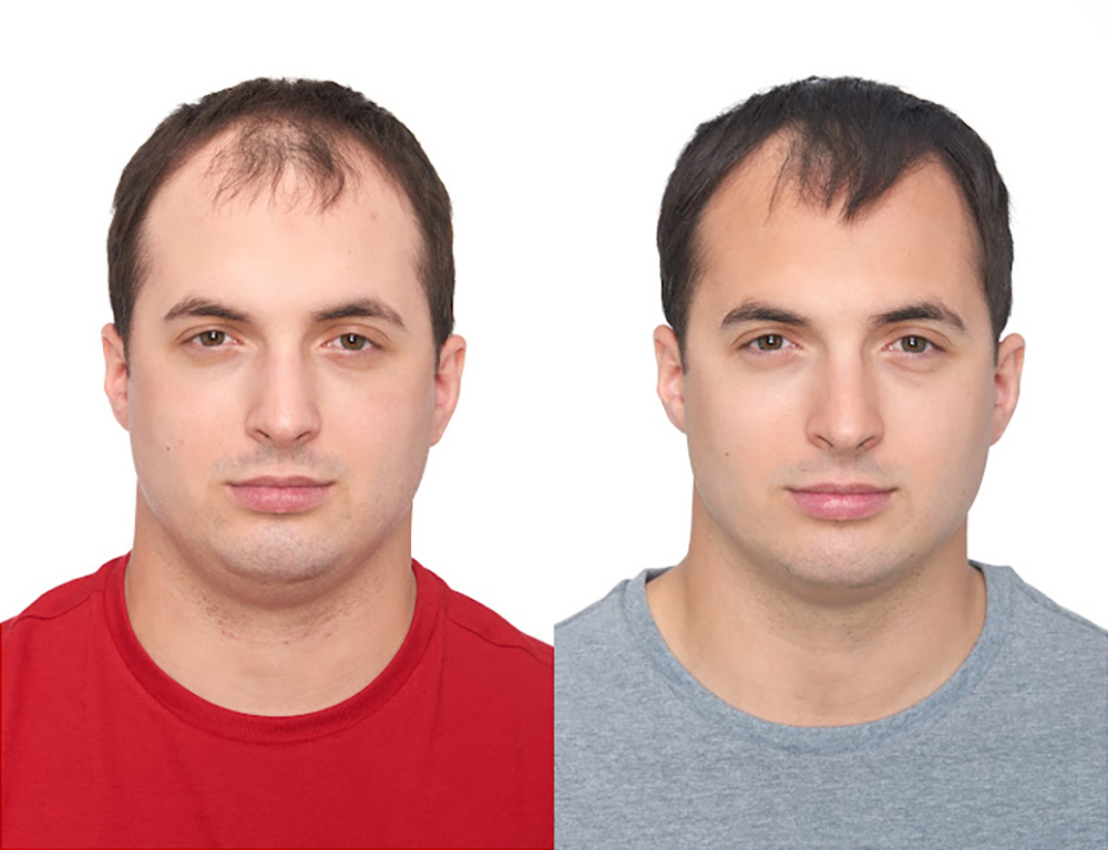 Bosley patient Jason B before and after