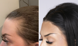 Bosley patient Britany G. before and after pictures - left