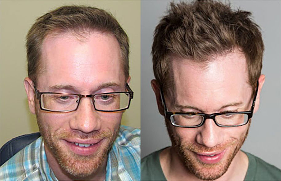 Bosley patient Adam K before and after