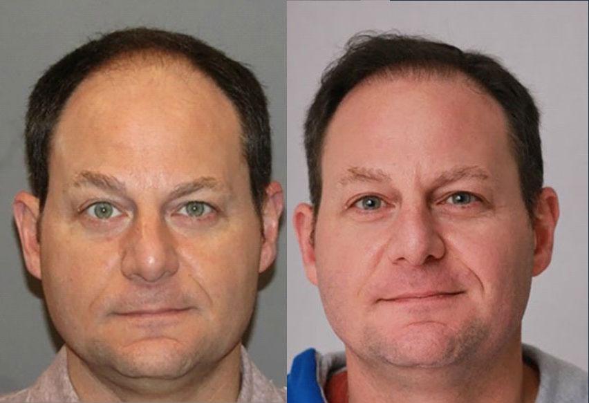 Bosley patient Adam L. before and after