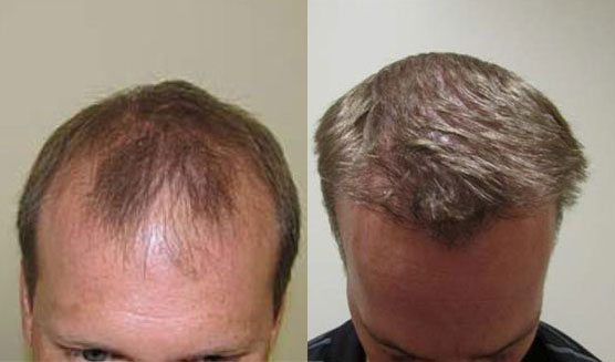 Bosley patient Adam S. before and after