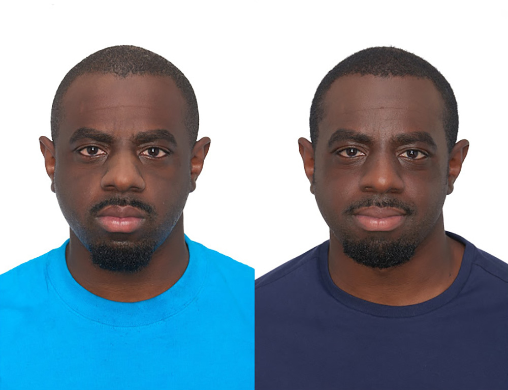 Bosley patient Akeem M before and after