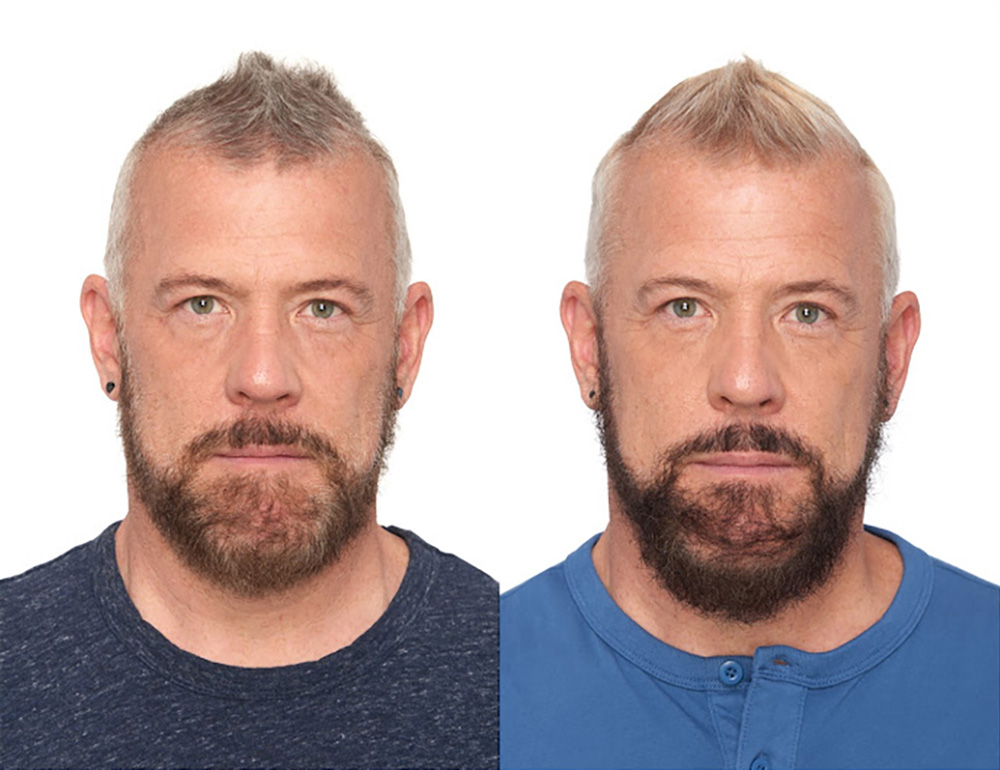 Bosley patient Akello S before and after