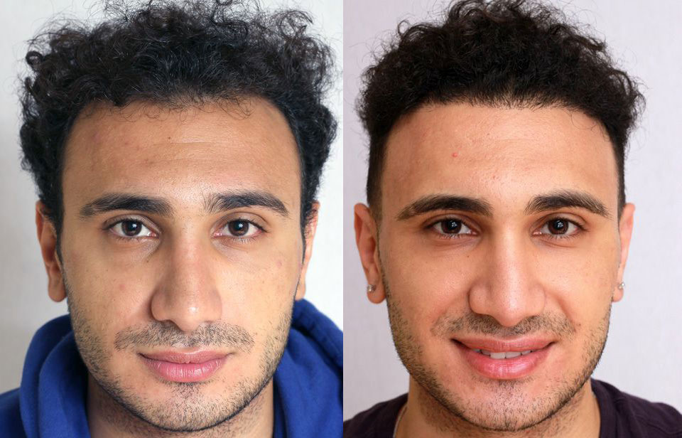Bosley patient Albert S. before and after