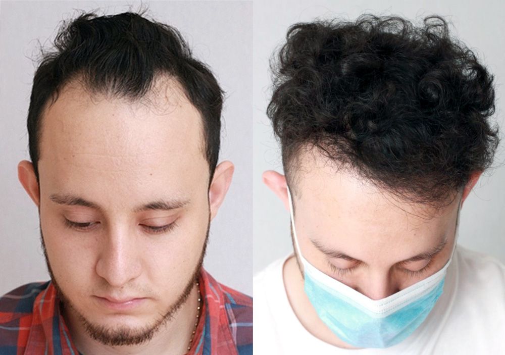 Bosley patient Alexis A before and after