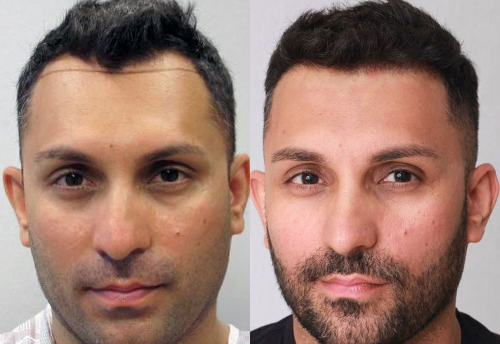 Bosley patient Amier Q. before and after