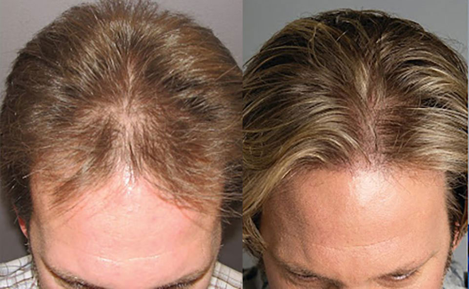 Bosley patient Andrew R before and after