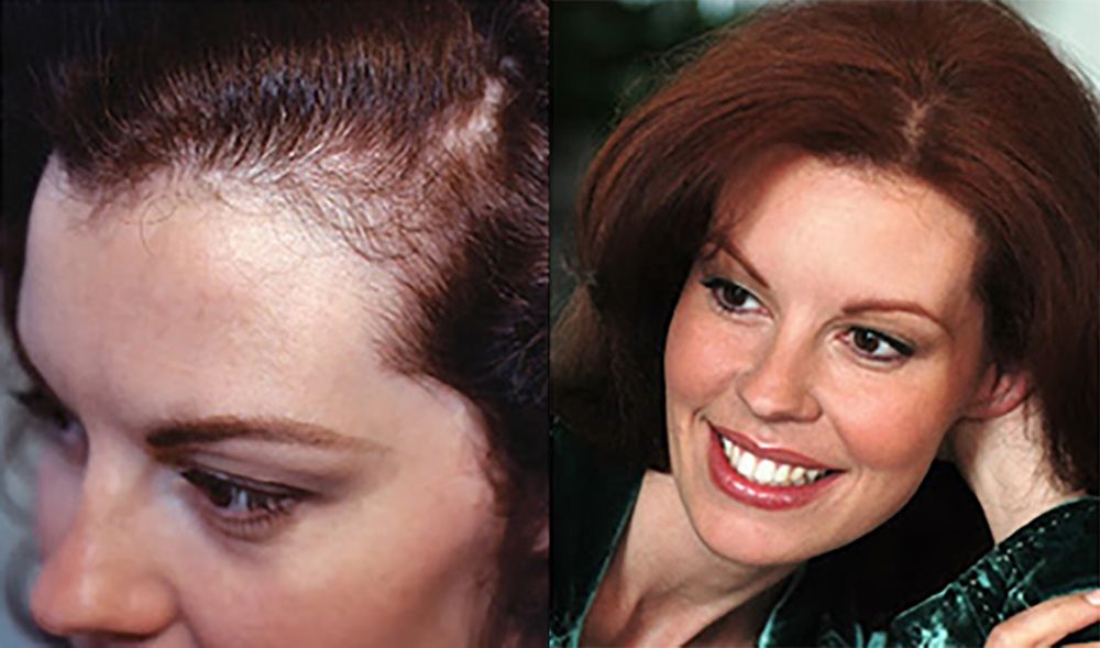 Bosley patient Angelique D before and after