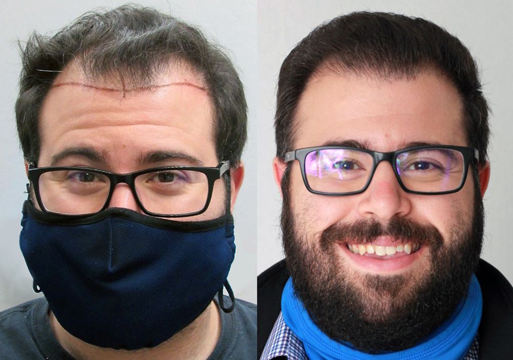 Bosley patient Anthony A before and after