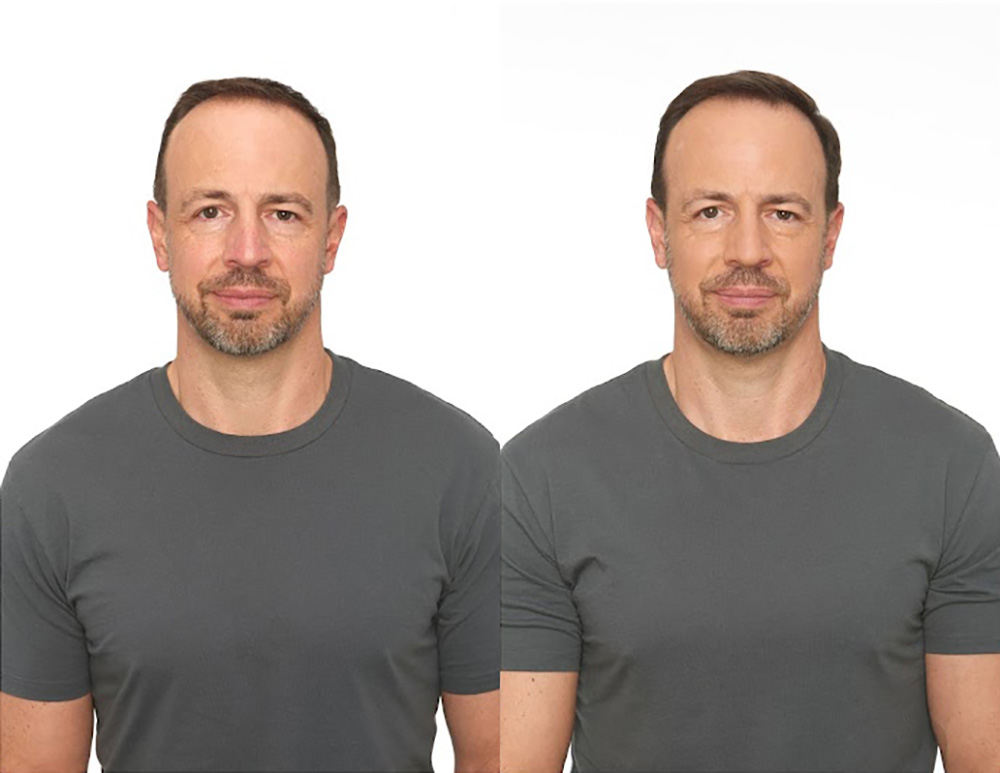 Bosley patient Aramis C before and after