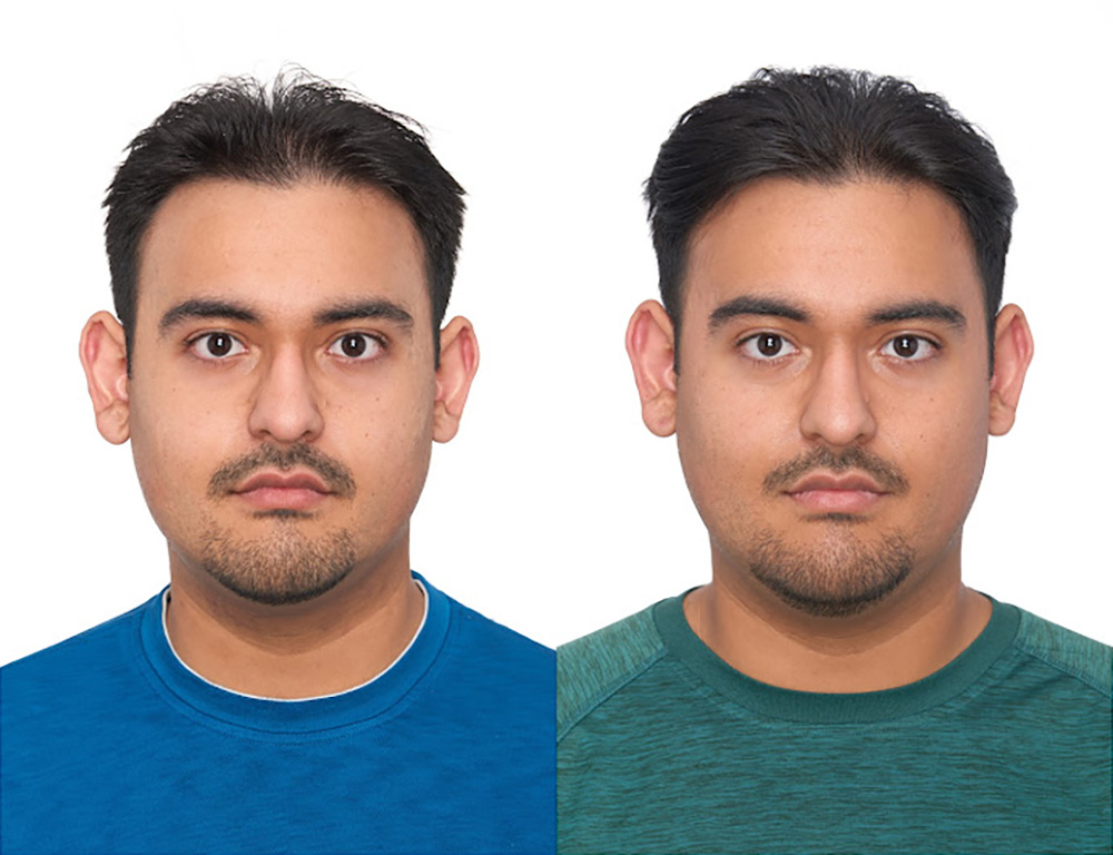 Bosley patient Arian C before and after