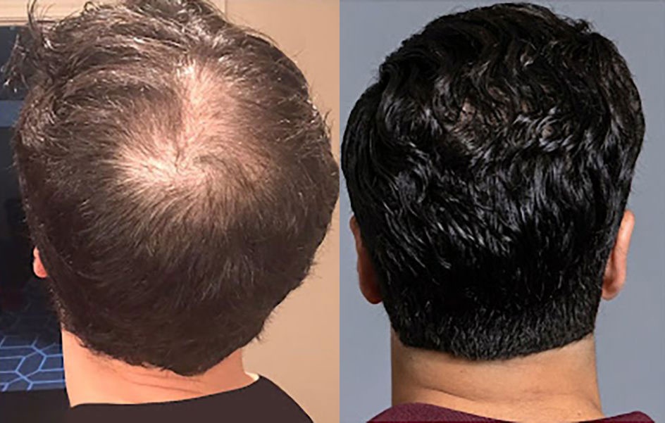 Bosley patient Aryan S. before and after