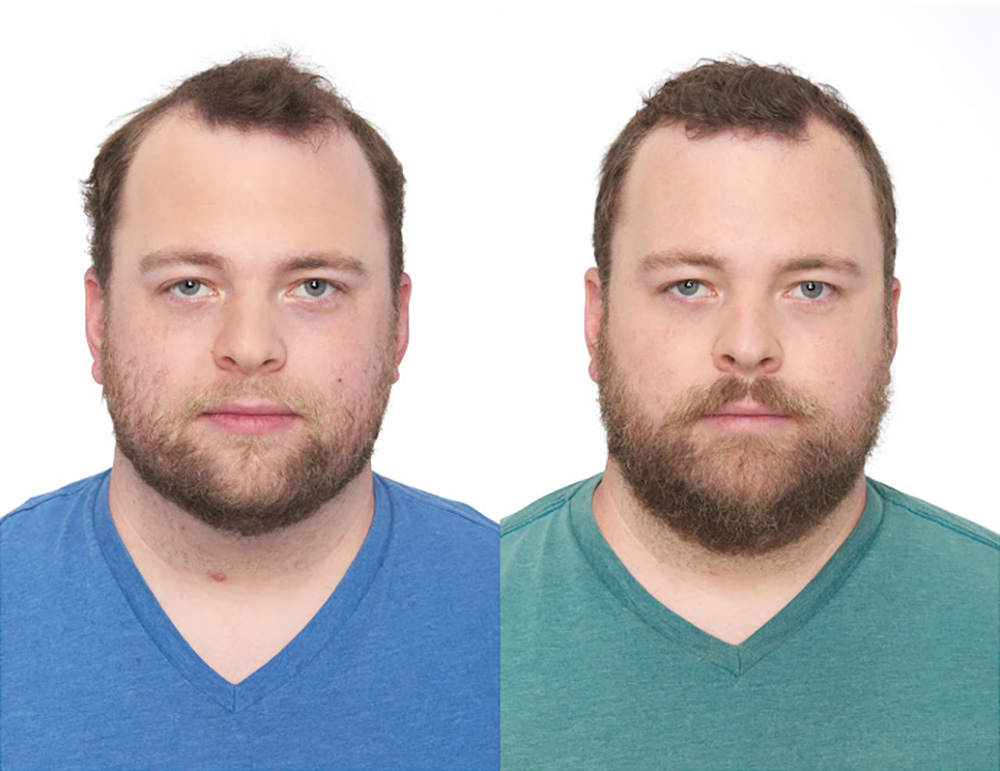 Bosley patient Barrett L before and after