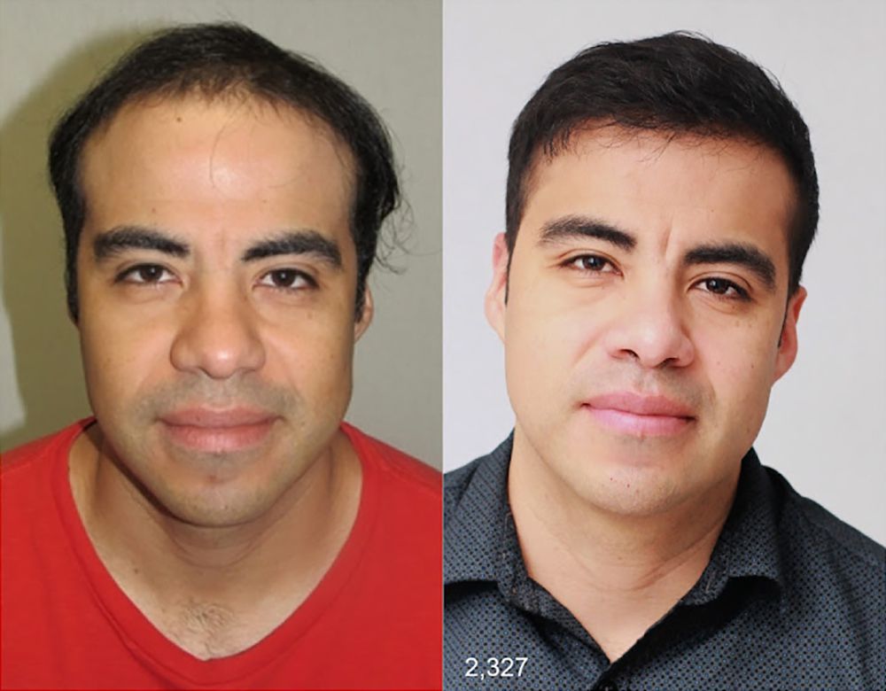 Bosley patient Benjamin S before and after