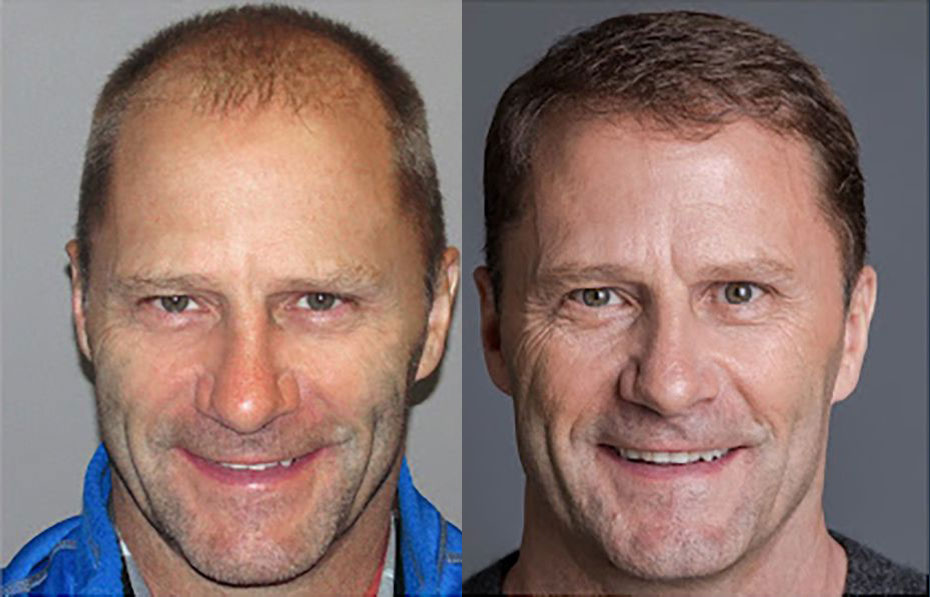 Bosley patient Bill O before and after