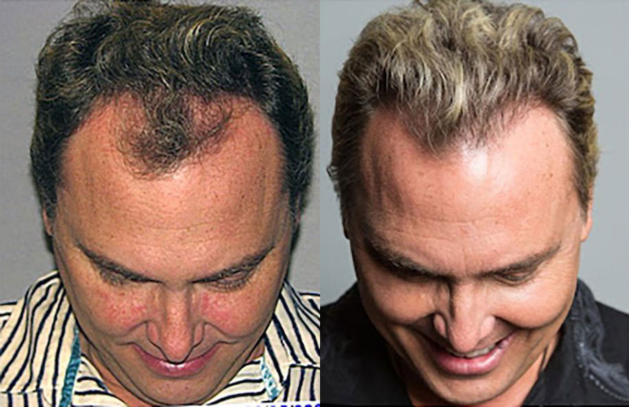Bosley patient Bill S before and after
