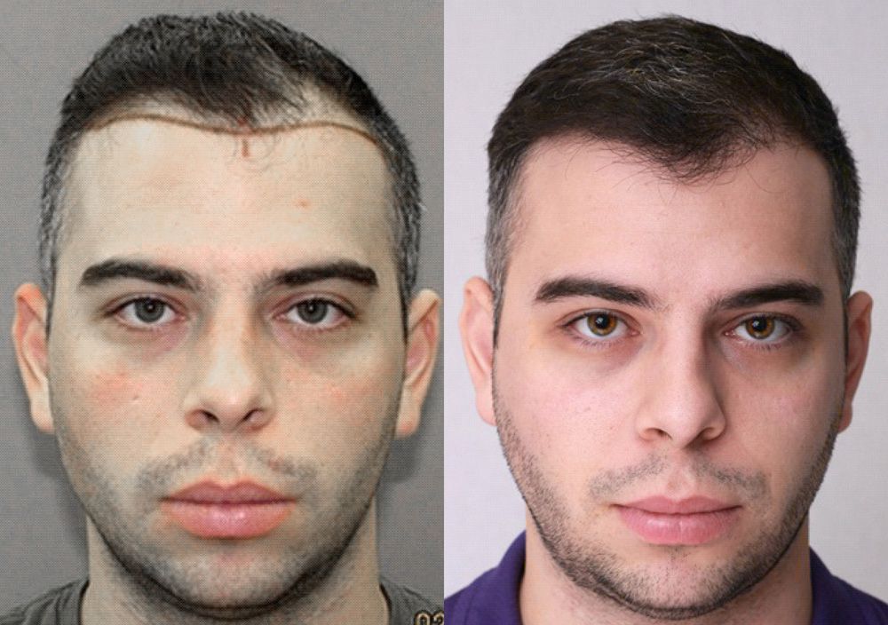 Bosley patient Brandon D before and after