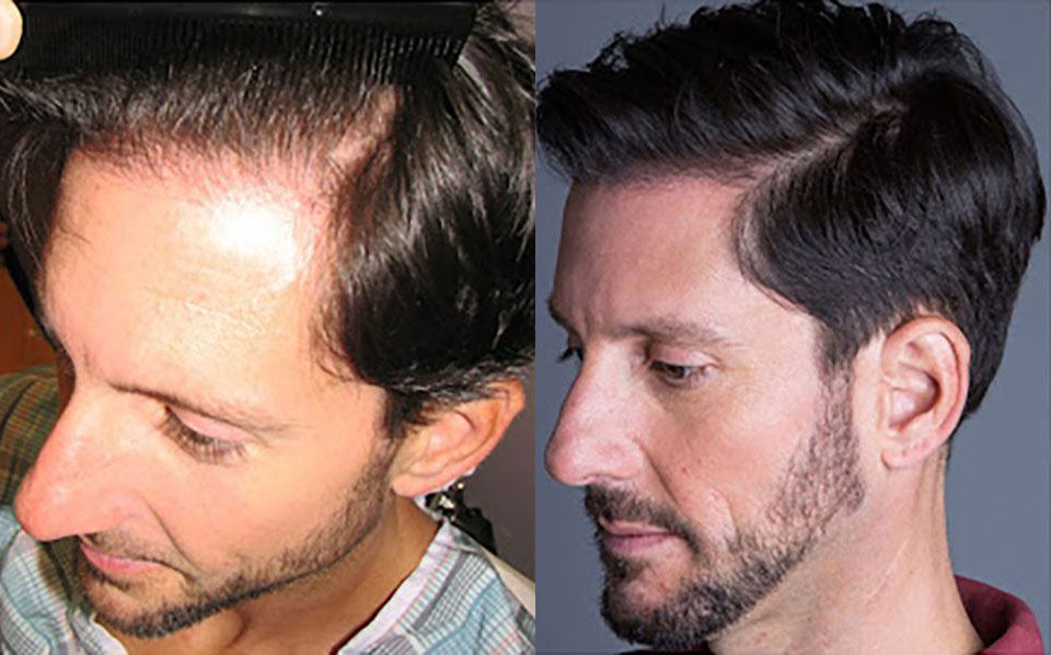 Hair Transplant Before/After Results for Men - Bosley Hair Transplant Hair Transplant Before/After Results for Men - Bosley Hair Transplant