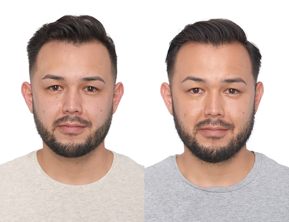 Bosley patient Bryan M before and after