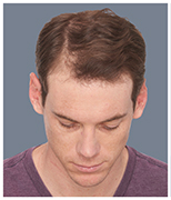 Bosley RX patient Cameron before