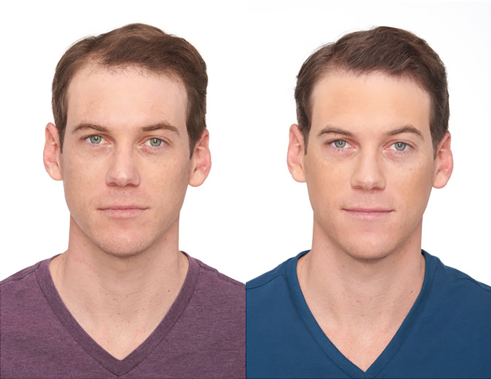 Bosley patient Cameron P before and after