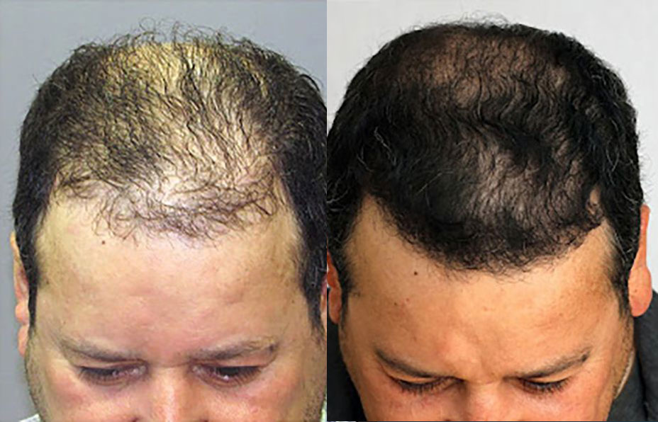 Is Bosley Hair Restoration Worth It Hair Transplant Before/After Results for Men - Bosley Hair Transplant