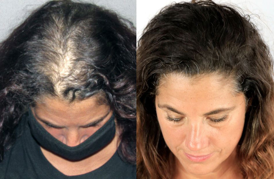 Charlene D., paciente de Bosley, antes y después