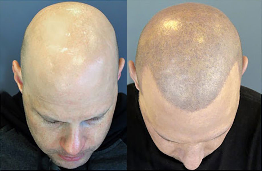 Chris B., paciente de Bosley, antes y después