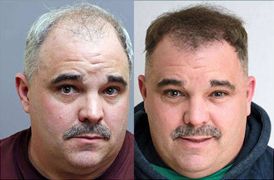 Bosley patient Chris D before and after