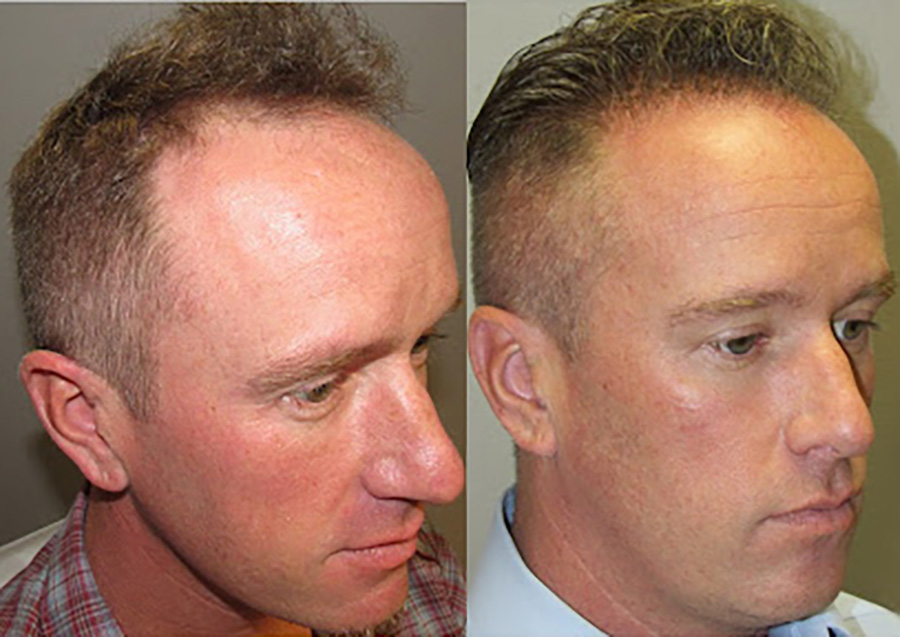 Bosley patient Chris H before and after