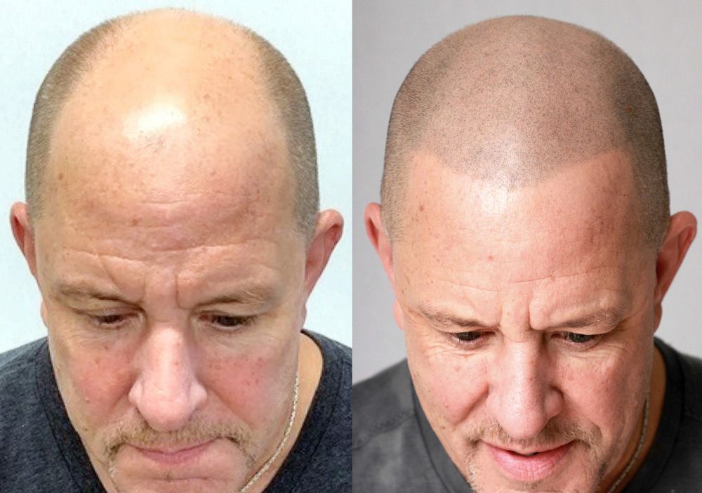 Bosley patient Craig C before and after