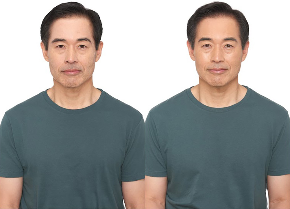 Bosley patient Craig T before and after