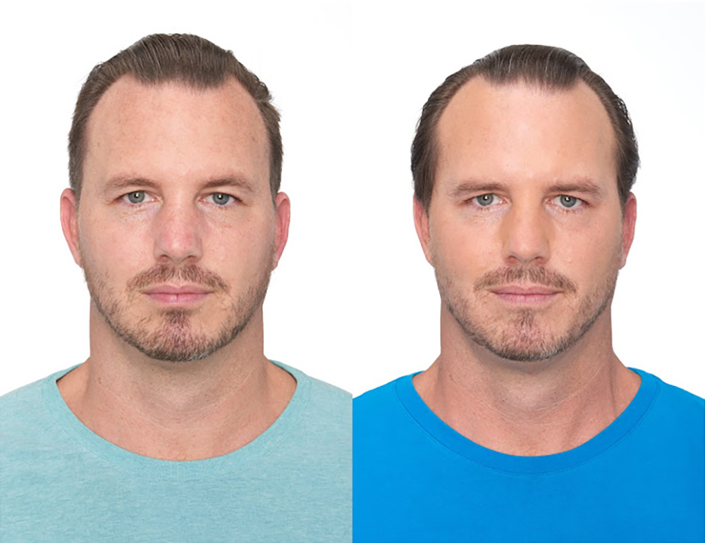 Bosley patient Dan R before and after