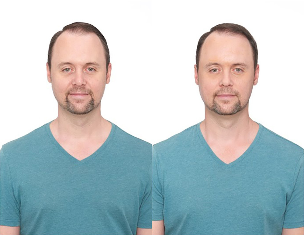 Bolsey patient Daniel D before and after