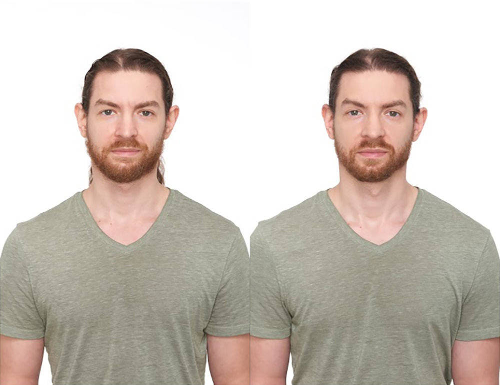 Bosley patient Daniel S before and after