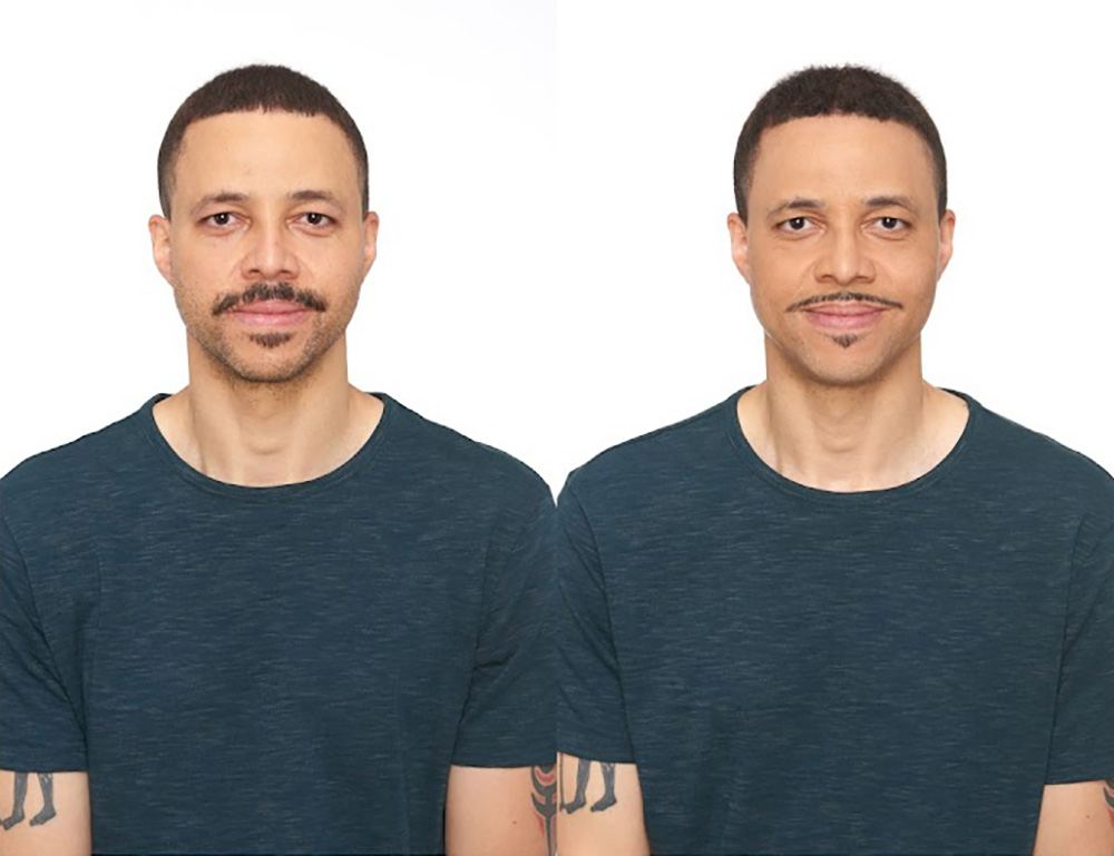 Bosley patient David G. before and after