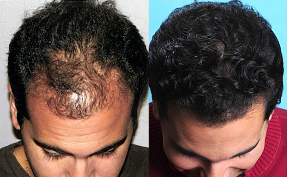 Bosley patient David V before and after