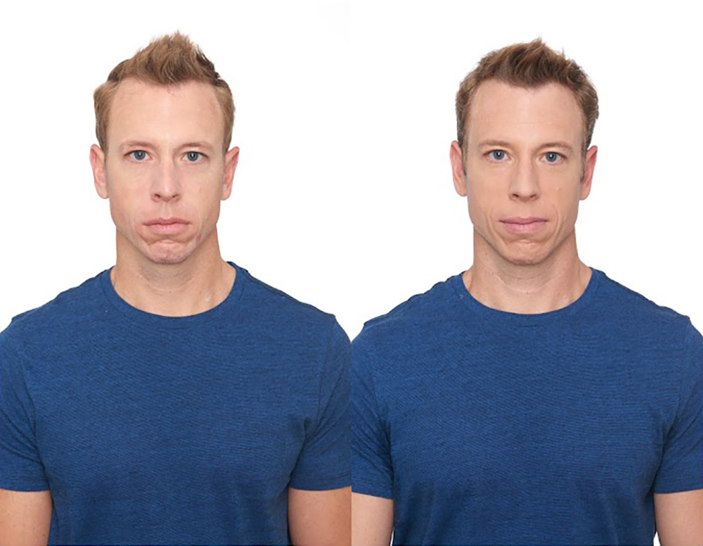 Bosley patient Dirk E before and after