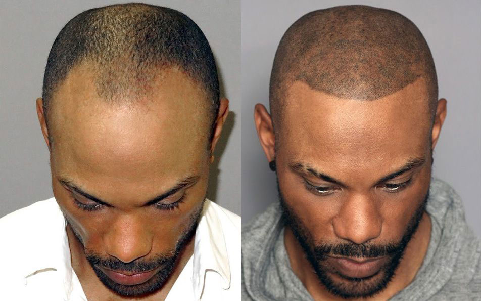 Bosley patient Ebony P. before and after