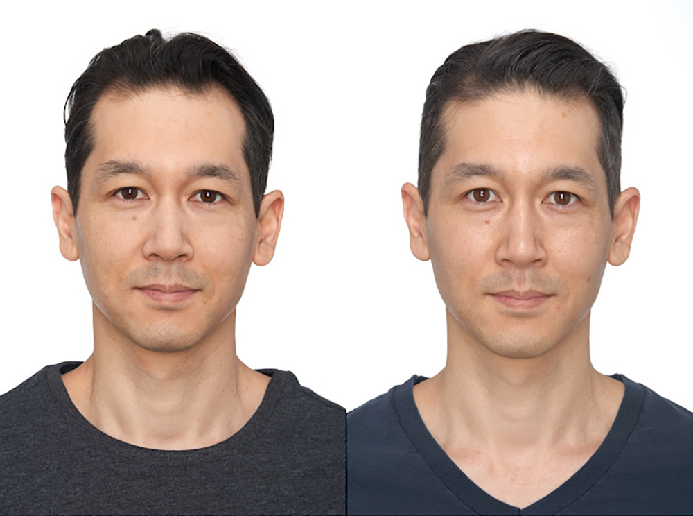 Bosley patient Evan S before and after