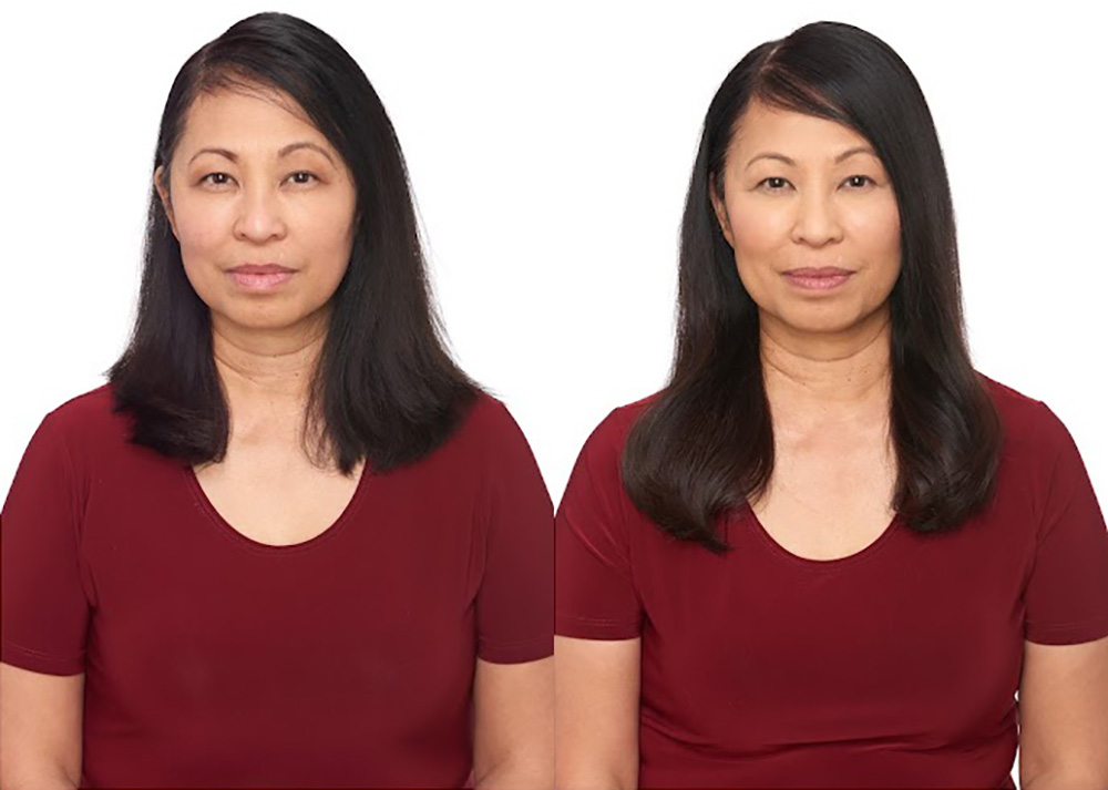 Bosley patient Franci N before and after