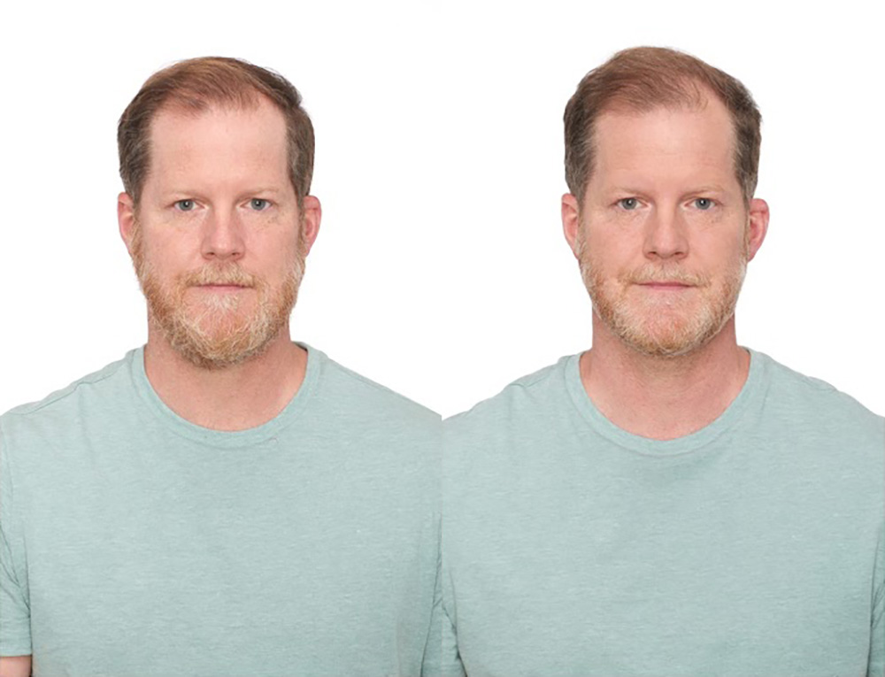 Bosley patient Gary I before and after