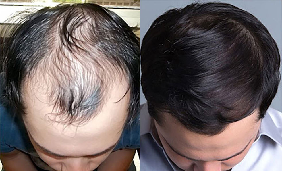 Bosley patient Grant G before and after