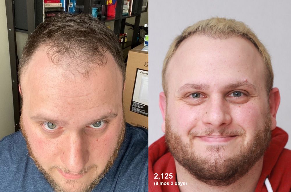 Bosley patient Gregory D before and after