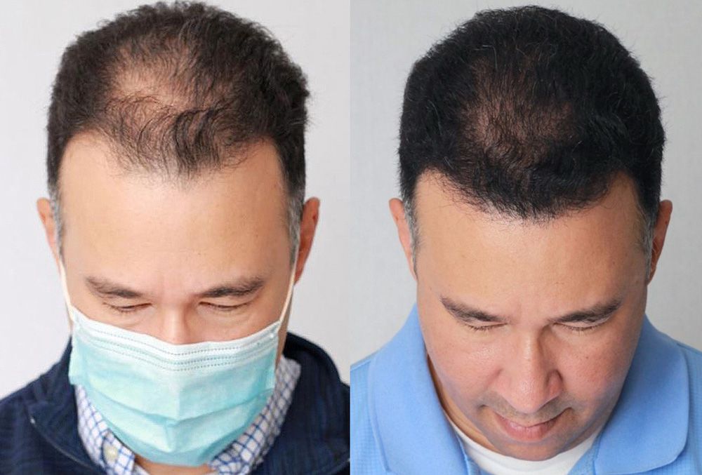 Bosley patient Guillermo B before and after